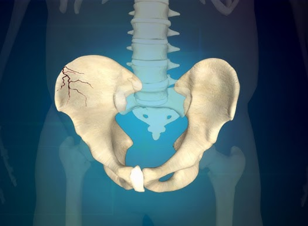 Pelviacetabular fracture cost in india
