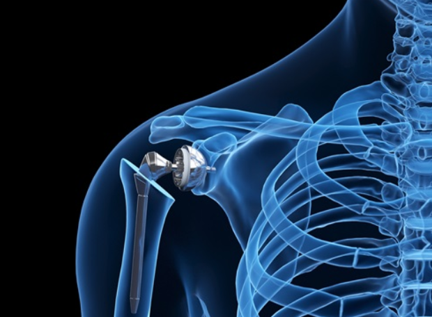 Shoulder replacement surgery near me, near bhubaneswar