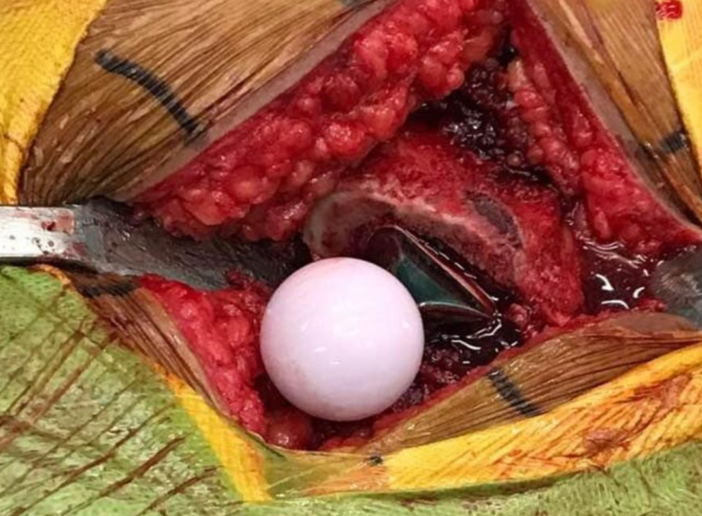 The best hip replacement surgery in Odisha, india using Oxinium implants