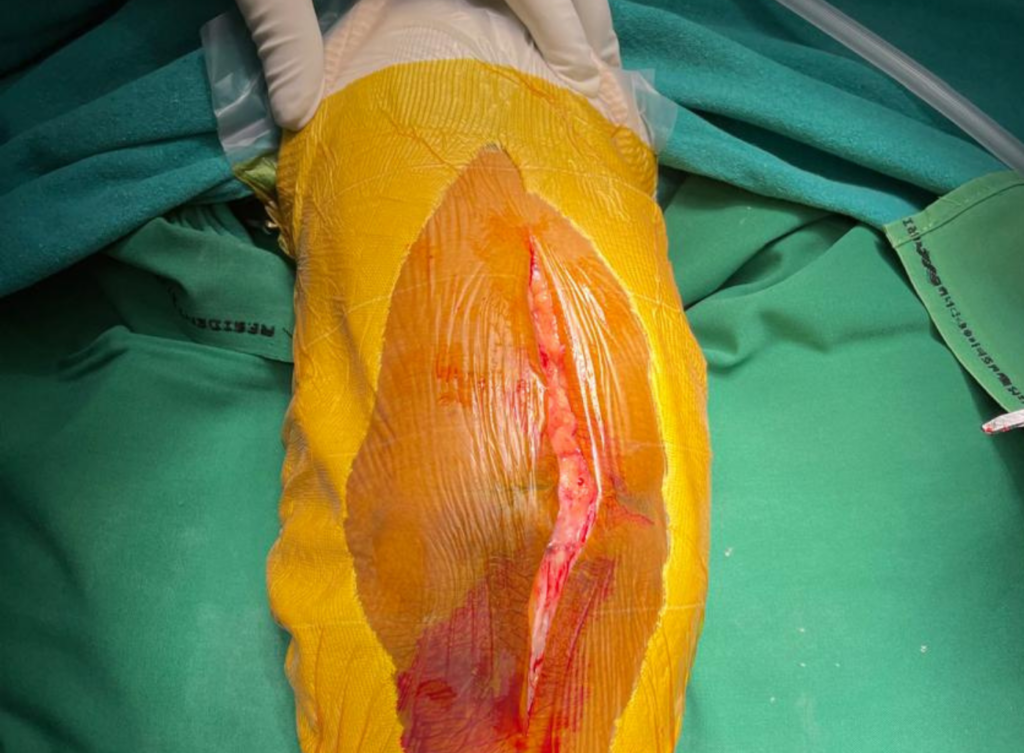 The best elbow replacement surgeon in bhubaneswar , odisha , india