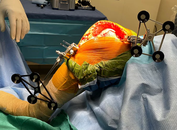 Robotic Knee replacement surgery in bhubaneswar by the best robotic knee replacement surgeon dr. sanjeev patnaik