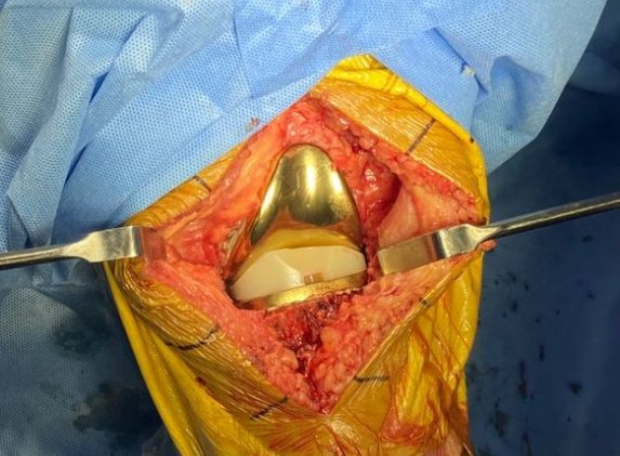 Knee replacement surgery using the gold knee - Smith & Nephew